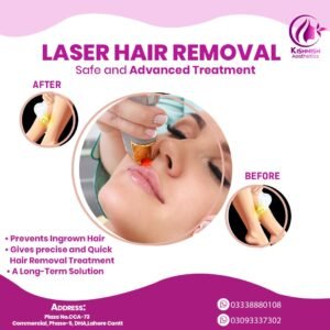 Read more about the article Laser Hair Removal