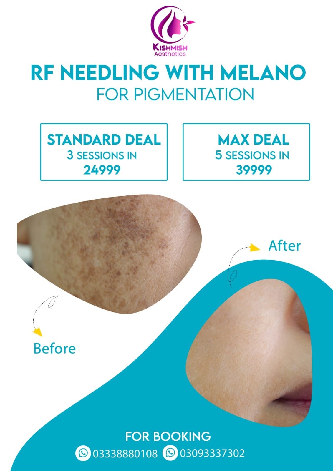 You are currently viewing RF Needling for Freckles, Hyperpigmentation, and Acne Scars
